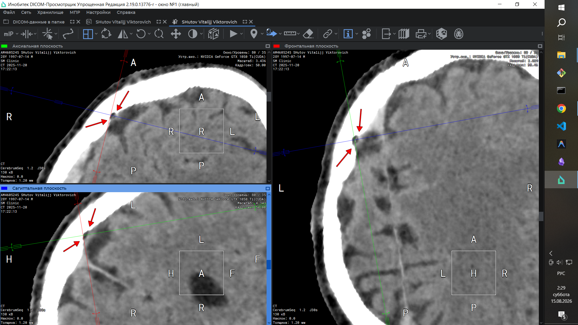 Illegal implant CT